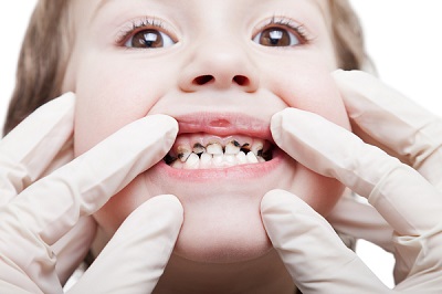 Hậu quả khó lường khi trẻ mắc bệnh răng miệng
