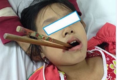 Bé gái 9 tuổi bị đôi đũa xuyên thẳng vào vòm họng