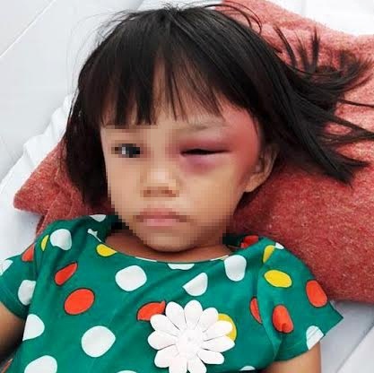 Bé gái 7 tuổi bị mẹ kế đánh sưng mắt, châm thuốc lá ​bỏng tay
