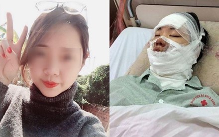 Bệnh nhân bị bỏng toàn bộ khuôn mặt do bóng bay phát nổ được điều trị tại Bệnh viện Xanh Pôn