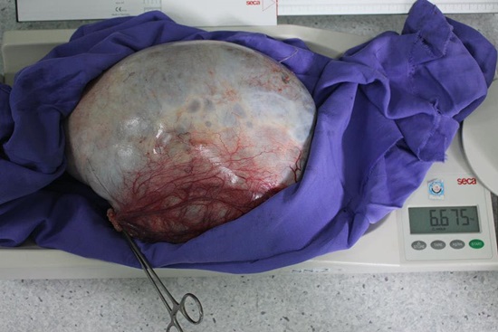 Khám đau tức vùng hạ vị, phát hiện u nang buồng trứng nặng… 6,5kg