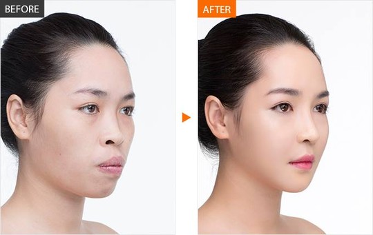 Hình ảnh trước và sau khi phẫu thuật thẩm mĩ