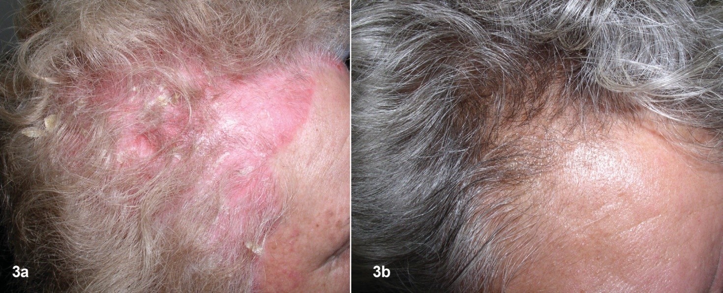 Bệnh nhân nữ 37 tuổi, vảy nến da đầu ở vùng đỉnh đầu và sau 6 tuần điều trị bằng các sản phẩm Dr Michaels thảo dược