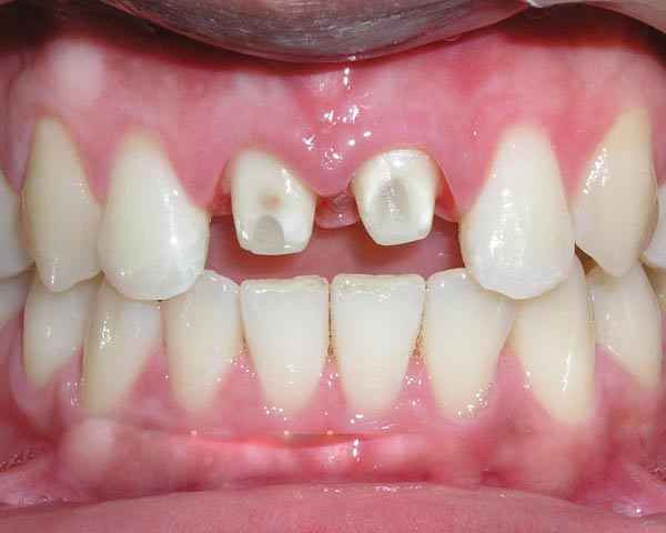 Những sai lầm khi đi mài răng, làm chết tủy để bọc răng 'xinh'