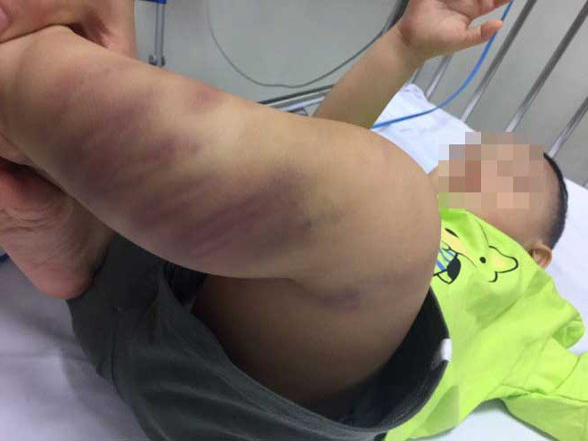 Hà Nội: Khởi tố vụ bé trai 1 tuổi bị đánh bầm tím toàn thân