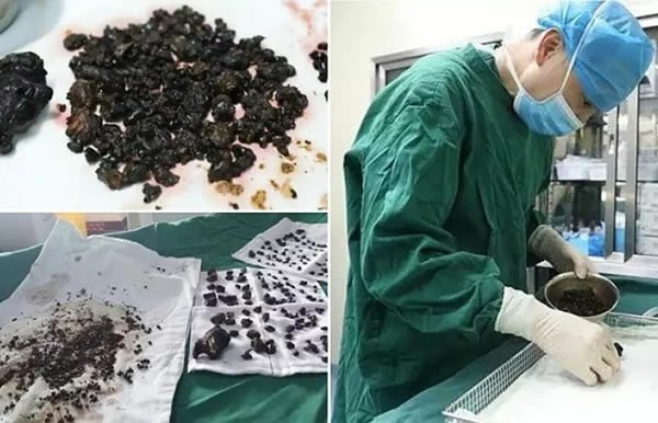 200 là số lượng viên sỏi các bác sĩ phẫu thuật tại bệnh viện Guanji, tỉnh Chiết Giang (Trung Quốc) đã lấy ra từ túi mật và gan của một người phụ nữ 45 tuổi tên là Chen, trong đó có những viên có kích thước to bằng quả trứng. (Nguồn Oddee)