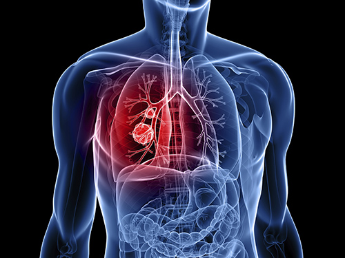 Phát hiện sớm ung thư phổi giúp tỷ lệ chữa khỏi cao