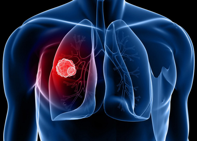 Cơ hội tầm soát miễn phí bệnh ung thư phổi