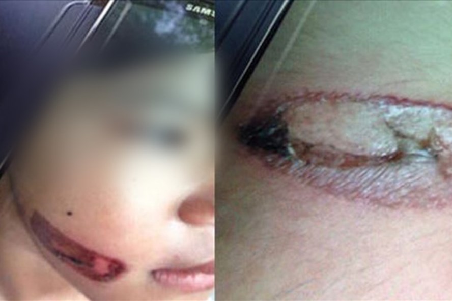 Vụ bé 7 tuổi bị dí sắt vào mặt: Trách mẹ kế 1, trách bố ruột 10