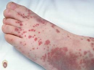 Những thông tin cần biết về các biểu hiện xuất huyết