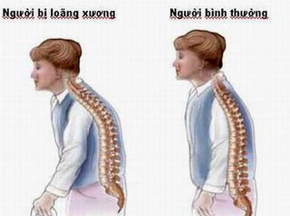 Tỷ lệ nam giới bị loãng xương không nhỏ