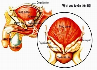Nam giới đề phòng u phì đại tuyến tiền liệt thế nào?