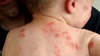 Khám miễn phí bệnh chàm