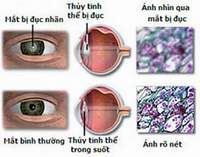 Những lưu ý sau khi thay thủy tinh thể