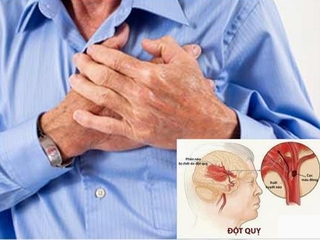 Đột quỵ - nguyên nhân hàng đầu gây tử vong