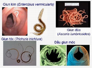 Giun có thể &quot;cướp&quot; đi mạng của con người
