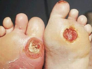 Bệnh tiểu đường và những biến chứng ở bàn chân