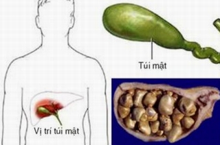 Mẹo đơn giản ngăn ngừa sỏi mật