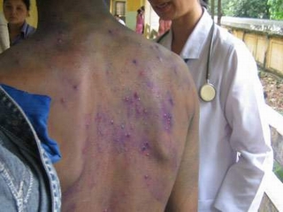 Thủy đậu vào mùa, nguy cơ biến chứng nặng