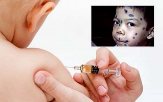 Yêu cầu kiểm định sớm vắcxin thủy đậu mới nhập khẩu