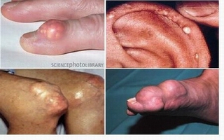 Người bệnh gout nên kiêng gì?