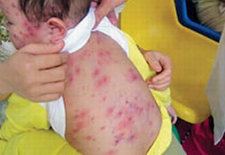 Đã có 110 trường hợp tử vong do sởi