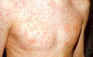 Những điều bạn nên biết về bệnh sởi