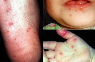 Dịch sởi chưa qua, bệnh tay chân miệng đã tới