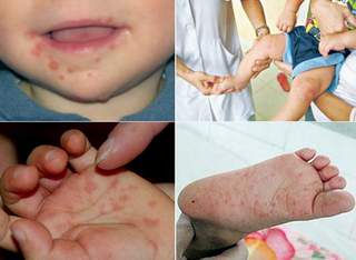 6 khuyến cáo phòng bệnh tay chân miệng