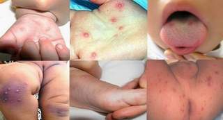 Mùa bệnh chân tay miệng - Những điều phụ huynh cần nhớ