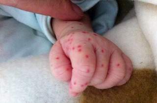 Đã mắc sốt xuất huyết có mắc lại?