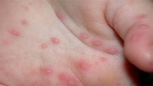 Tuyên truyền sẽ ngăn ngừa sự lan rộng của dịch bệnh