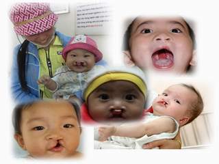 Phẫu thuật miễn phí cho trẻ dị tật khe hở môi, hở vòm miệng