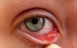 Mẹo đơn giản ngừa đau mắt đỏ mùa hè