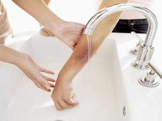 Bạn đã biết cách sơ cứu khi bị bỏng?