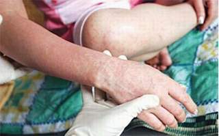 Cứu sống người lớn mắc sởi biến chứng viêm não