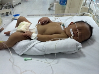 Thay máu cứu sống bé sơ sinh do bất đồng nhóm máu với mẹ