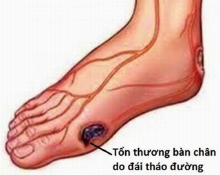 Cảnh giác với những biến chứng của đái tháo đường