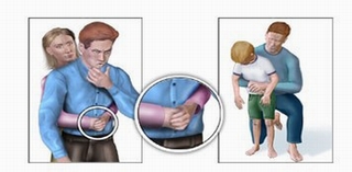 Thủ thuật sơ cứu khi trẻ hóc dị vật