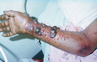 Bạn biết gì về dịch bệnh Ebola?