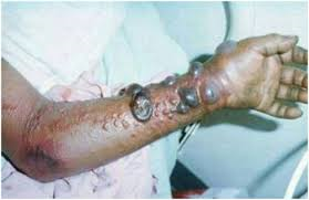Bộ Y tế khẳng định chưa có người Việt nào mắc Ebola