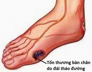 Ăn gạo trắng tăng nguy cơ bị đái tháo đường