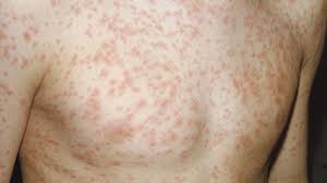 Ai dễ mắc bệnh Rubella?