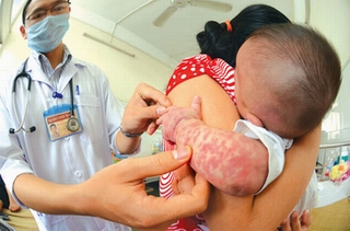 Chăm sóc người mắc sởi - rubella thế nào?