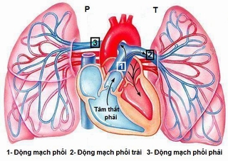 Bệnh hiếm gặp: Bé gái không có động mạch phổi phải