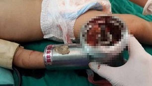 Tai nạn hi hữu:: Bé 3 tuổi mất bàn tay vì máy xay thịt