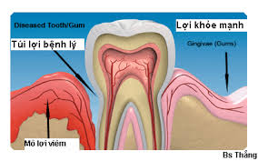 Viêm lợi và những biến chứng nguy hiểm