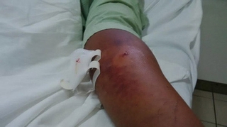 Những việc cần làm ngay khi bị rắn độc cắn