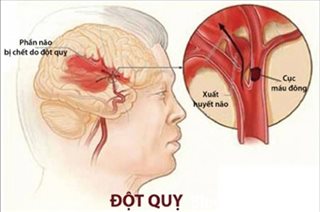 Đột quỵ não gây nhiều biến chứng nặng nề