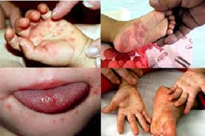 Bệnh tay chân miệng đe dọa nhiều người